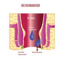 interne les hémorroïdes et externe les hémorroïdes. les hémorroïdes et inflammation cause saignement par le fistule de le patient.cross section de le rectum et anal canal vecteur