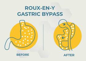 gastrique contourne rny poids perte chirurgie vecteur illustration icône roux-en-y