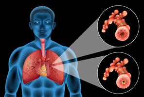 Diagramme montrant les poumons humains et la maladie vecteur
