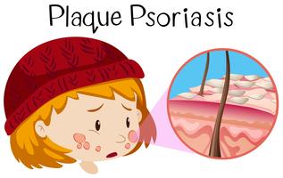 Anatomie humaine du psoriasis en plaques vecteur