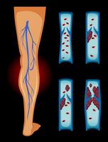Caillot de sang dans la jambe humaine
