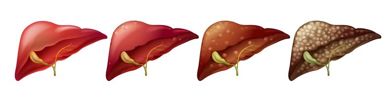 Différents stades du foie humain vecteur