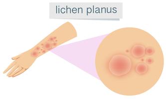 Peau humaine avec lichen plan vecteur