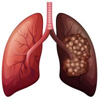 Cancer normal du poumon et du poumon