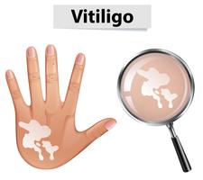 Main humaine et vitiligo vecteur