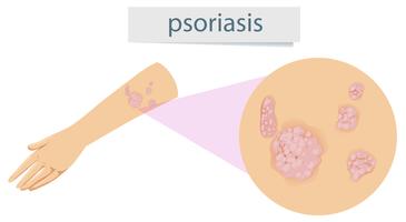 Psoriasis magnifié au bras vecteur