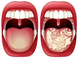 Vecteur de bouche saine et de virus