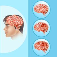 Diagramme montrant le cancer du cerveau chez l&#39;homme vecteur