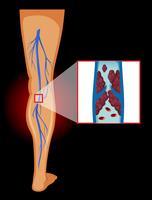 Image médicale des varices vecteur