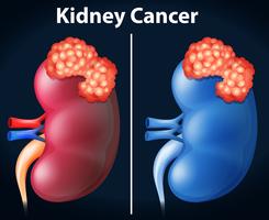 Deux diagramme de cancer du rein vecteur