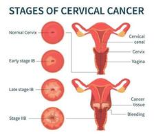 stades du schéma infographique blanc du cancer du col de l'utérus vecteur