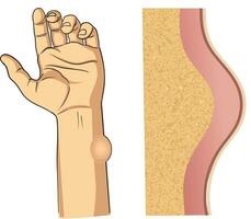 lipome illustration dans main vecteur