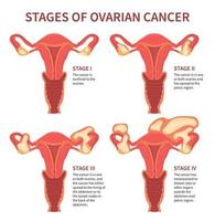 quatre stades du cancer de l'ovaire de la femme isolé vecteur