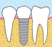 conception d'implants dentaires vecteur