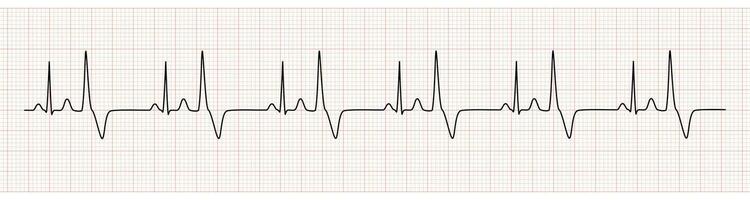 ekg moniteur montrant sinus rythme avec bigéminisme pvc vecteur