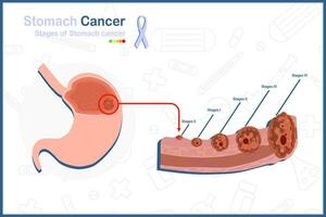 médical vecteur illustration concept dans plat style de estomac cancer. 5 étapes de estomac cancer et estomac tumeur illustration.isolé sur blanc Contexte.