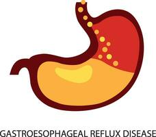 gastro-oesophagien reflux maladie. estomac Gerd brûlures d'estomac œsophage médical illustration. vecteur