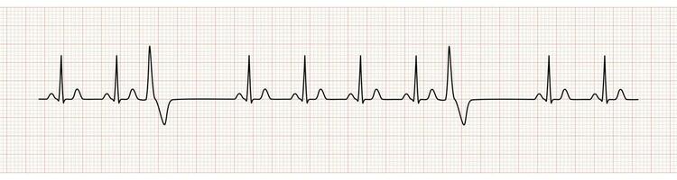 ekg moniteur montrant sinus rythme avec pvc vecteur