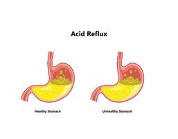 reflux ou gastro-oesophagien reflux, brûlures d'estomac. estomac maladie, estomac problème maladie concept. vecteur dessin