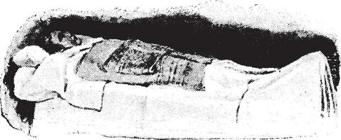 fomentation, humide tissu plié et dans position, ancien gravure. vecteur