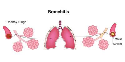 bronchite science conception vecteur illustration diagramme