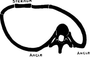 changements dans le thorax Suivant scoliose de le colonne vertébrale, ancien illustration. vecteur