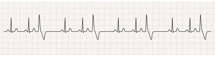 ekg moniteur montrant sinus rythme avec trijumeau pvc vecteur