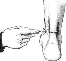 ténotomie de le Achille tendon, ancien gravure. vecteur