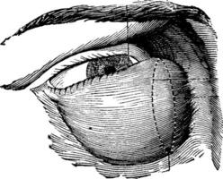 très développé lacrymal tumeur, ancien gravure vecteur