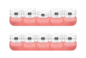 correction de la morsure à l'aide d'un système d'accolades. alignement des dents. vecteur. vecteur