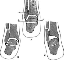 transversal section par le inférieur jambe, ancien illustration. vecteur