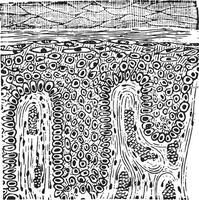 squameux épithéliome, ancien gravure. vecteur