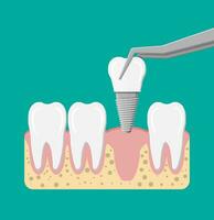 dent restauration. installation de le dentaire implant. dentaire prothèses. artificiel les dents avec acier broche. oral se soucier, stomatologie et dentisterie. vecteur illustration dans plat style