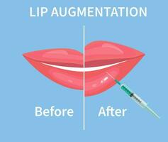 lèvre augmentation. avant et après lèvre remplissage injections. hyaluronique acide injections. vecteur illustration dans plat style