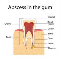 abcès dans le gencive diagramme vecteur
