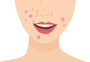 Jeune femme visage avec peau acné, boutons, points noirs vecteur illustration. acné peau visage problème