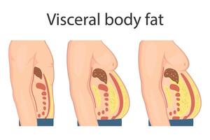 médical affiche à propos viscéral graisse. abdominal graisse entoure le interne des portes de le abdominal cavité. en surpoids maladie concept. poids perte, liposuccion, et régime. vecteur