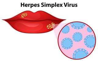 Diagramme montrant le virus de l&#39;herpès simplex vecteur