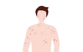 Jeune homme avec peau acné, boutons, points noirs vecteur illustration. acné peau problème concept
