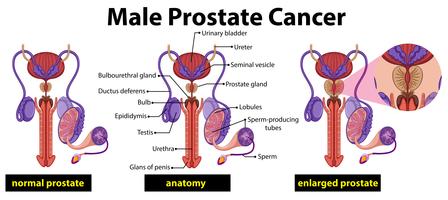 Diagramme du cancer de la prostate chez l&#39;homme vecteur