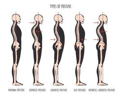 type de posture, posturale syndromes infographie. squelettique échantillons de retour problème cyphose, lordose et plat dos. Ordinaire posture médical éducatif affiche. vecteur