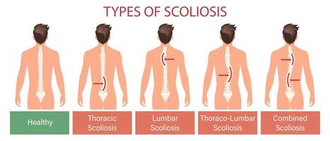 les types de scoliose, spinal maladie. infographie bannière avec Humain scoliose colonne vertébrale. soins de santé et médicament. illustration, affiche vecteur