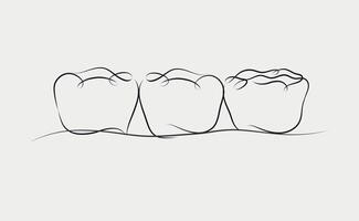 implanté les dents avec couronne pont illustration dessin dans linéaire style sur blanc Contexte vecteur