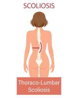 scoliose, une maladie de le colonne vertébrale. infographie bannière avec scoliose de le Humain colonne vertébrale. soins de santé et médicament. illustration vecteur