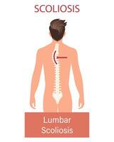 scoliose, une maladie de le colonne vertébrale. infographie bannière avec scoliose de le Humain colonne vertébrale. soins de santé et médicament. illustration vecteur