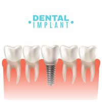 Vue de côté du modèle d&#39;implant dentaire vecteur