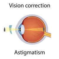 correction de la vision de l'illustration de l'astigmatisme. troubles de la vue. défaut des yeux corrigé par le concept de lentille. globe oculaire d'anatomie détaillée avec défaut d'astigmatisme. vecteur isolé