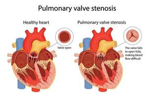 sténose de la valve pulmonaire. illustration anatomique vecteur