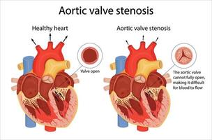 l'illustration médicale montre la différence entre une valve aortique normale et une valve sténosée. illustration de style dessin animé vecteur