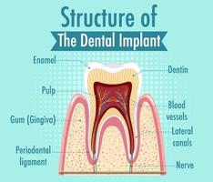 infographie de l'homme dans la structure de l'implant dentaire vecteur